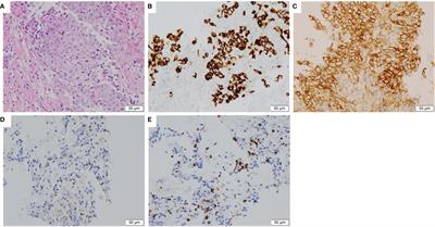 Case Report: Complete Response to Nivolumab in a Patient With Programmed Cell Death 1 Ligand 1-Positive and Multiple Gene-Driven Anaplastic Lymphoma Kinase Tyrosine Kinase Inhibitor-Resistant Lung Adenocarcinoma